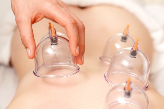Cupping therapy being performed on patient's back