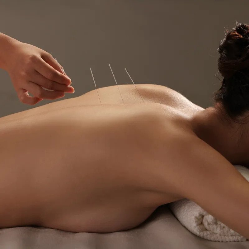 Dry needling treatment being performed